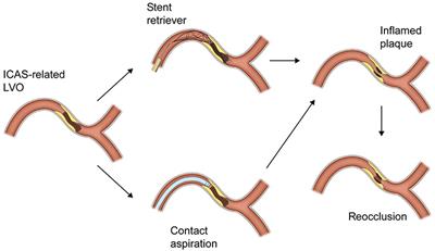 Endovascular Treatment of Acute Stroke Due to Intracranial Atherosclerotic Stenosis–Related Large Vessel Occlusion